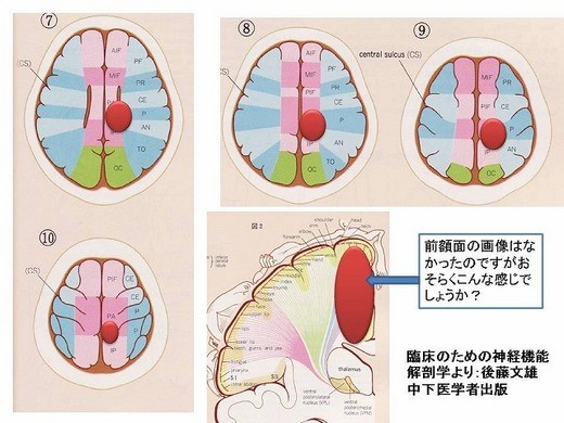 前大脳動脈領域の出血に対するボバースアプローチ 脳卒中 脳梗塞 脳出血 片麻痺のリハビリ