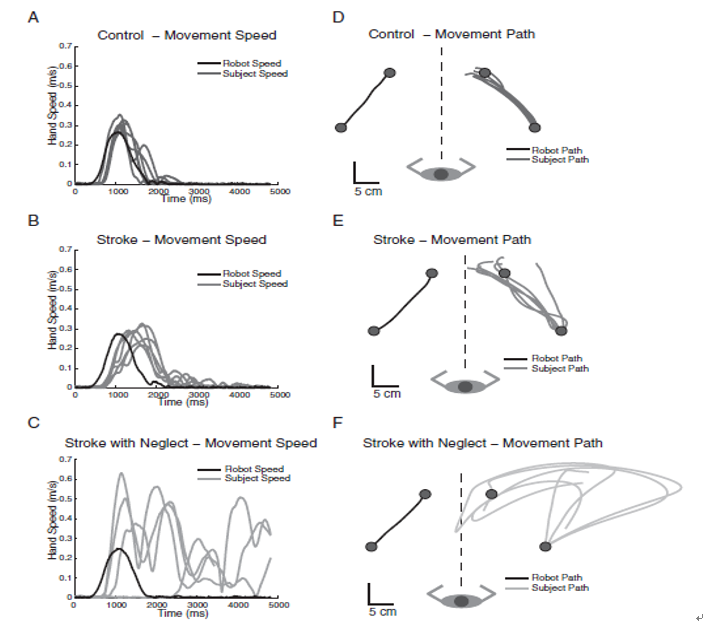 図：Relationship Between Visuospatial Neglect and Kinesthetic Deficits After Stroke