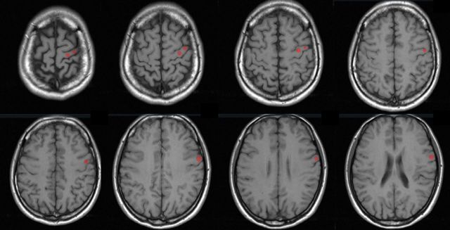 脳科学トピック 脳画像で皮質脊髄路の損傷を把握すべき理由とは 脳卒中 神経系 自費リハビリ施設 Stroke Lab 東京