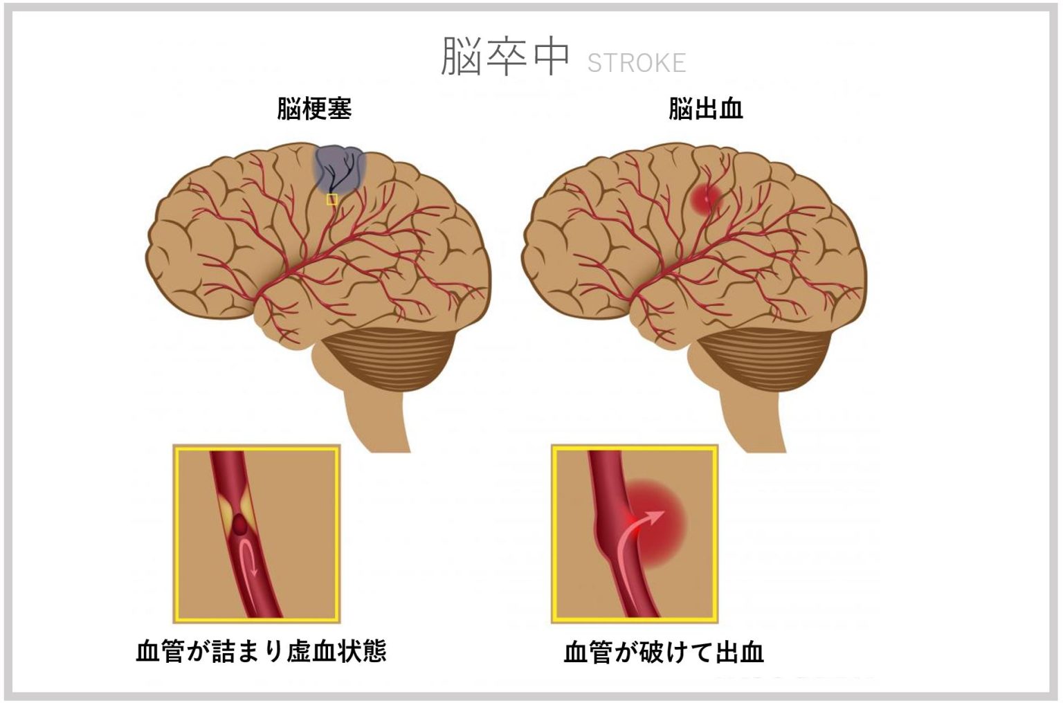 %e8%84%b3%e5%8d%92%e4%b8%ad%e3%81%a8%e3%81%af – STROKE LAB 東京/大阪 自費リハビリ ...