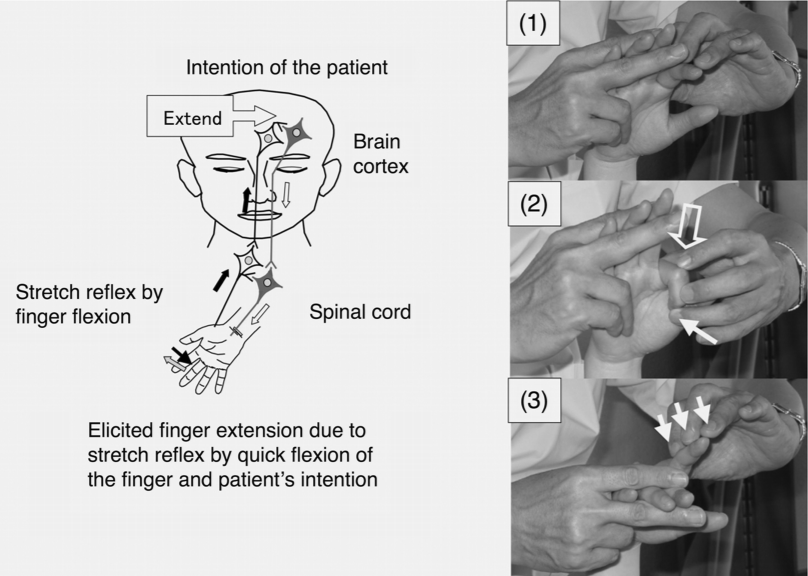 10582円 話題の行列 スマートクッション調整可能な指トレーニングデバイス 脳卒中片麻痺患者の腱運動のための手のリハビリテーショントレーニング指装具