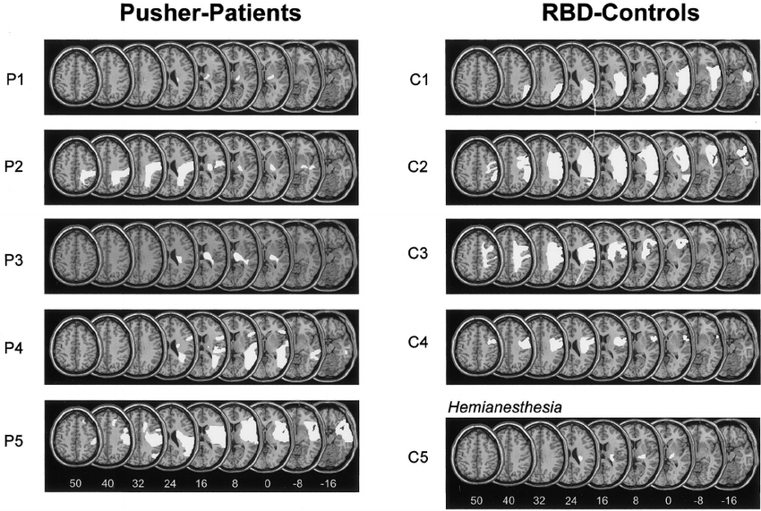 figure-1-infarcted-areas-of-the-patients-with-contraversive-pushing-p1-5-and-of-the