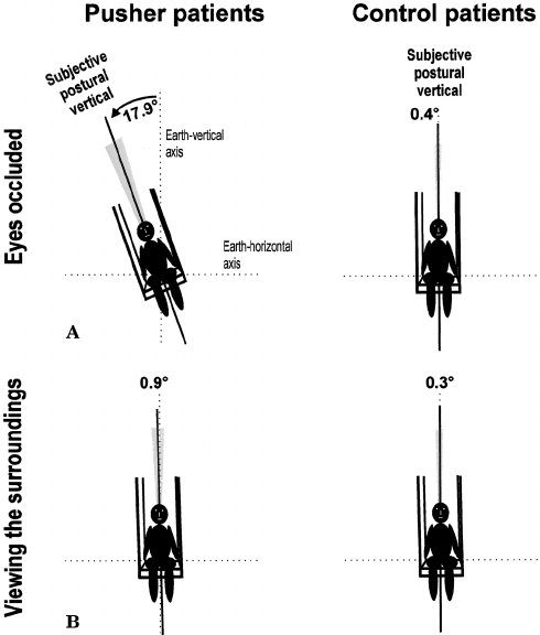 figure-2-schematic-drawing-of-the-subjects-perceived-postural-vertical-with-occluded