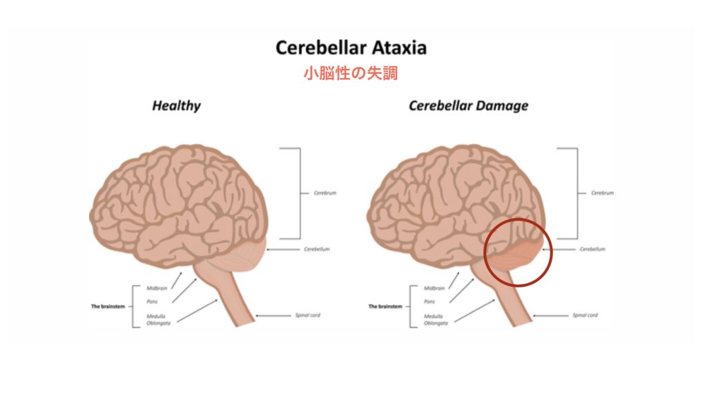 小脳性の失調