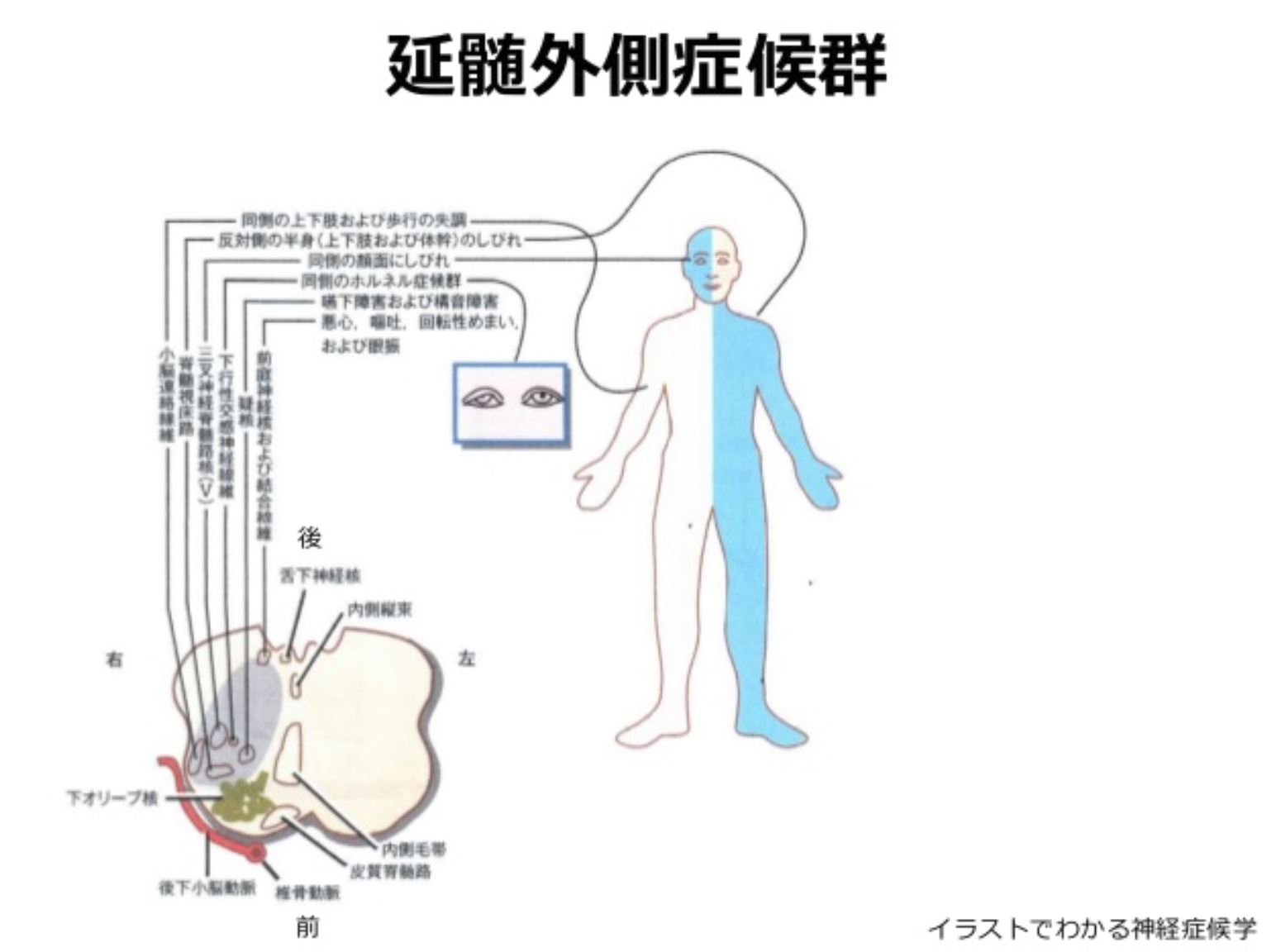 梗塞 延髄