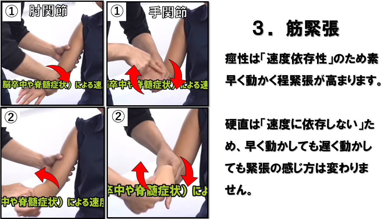 上肢の神経学的検査：筋緊張（2）