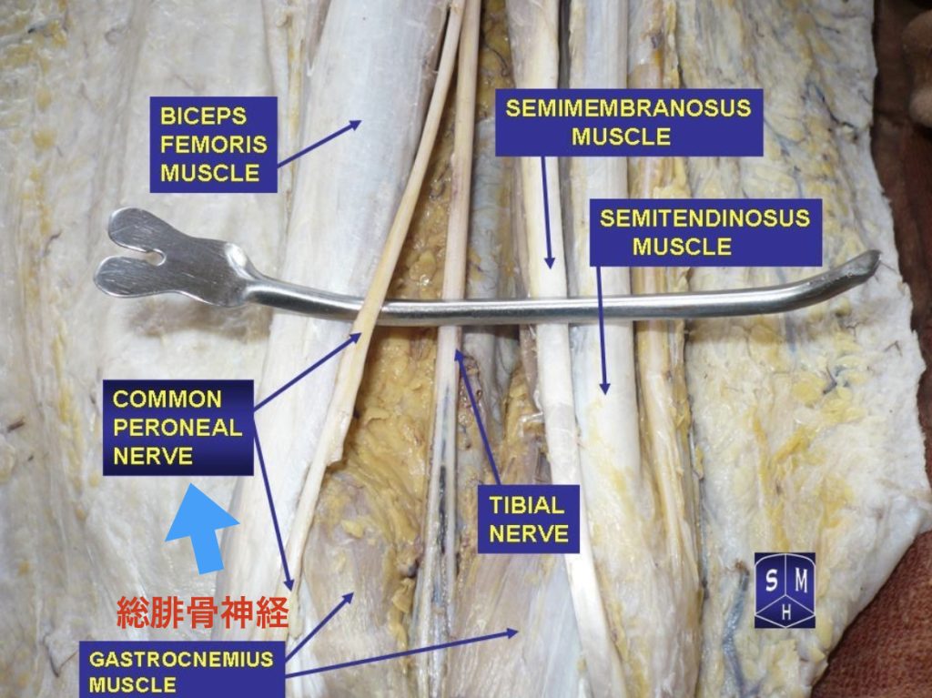 総腓骨神経　Wikipedia