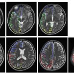 【2022年版】MRIとCTの違い分かる？療法士向け分かりやすい脳画像の見方/下肢運動とfMRIの論文紹介
