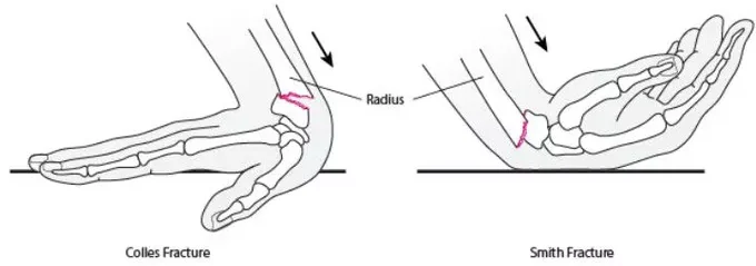 Collies fracture