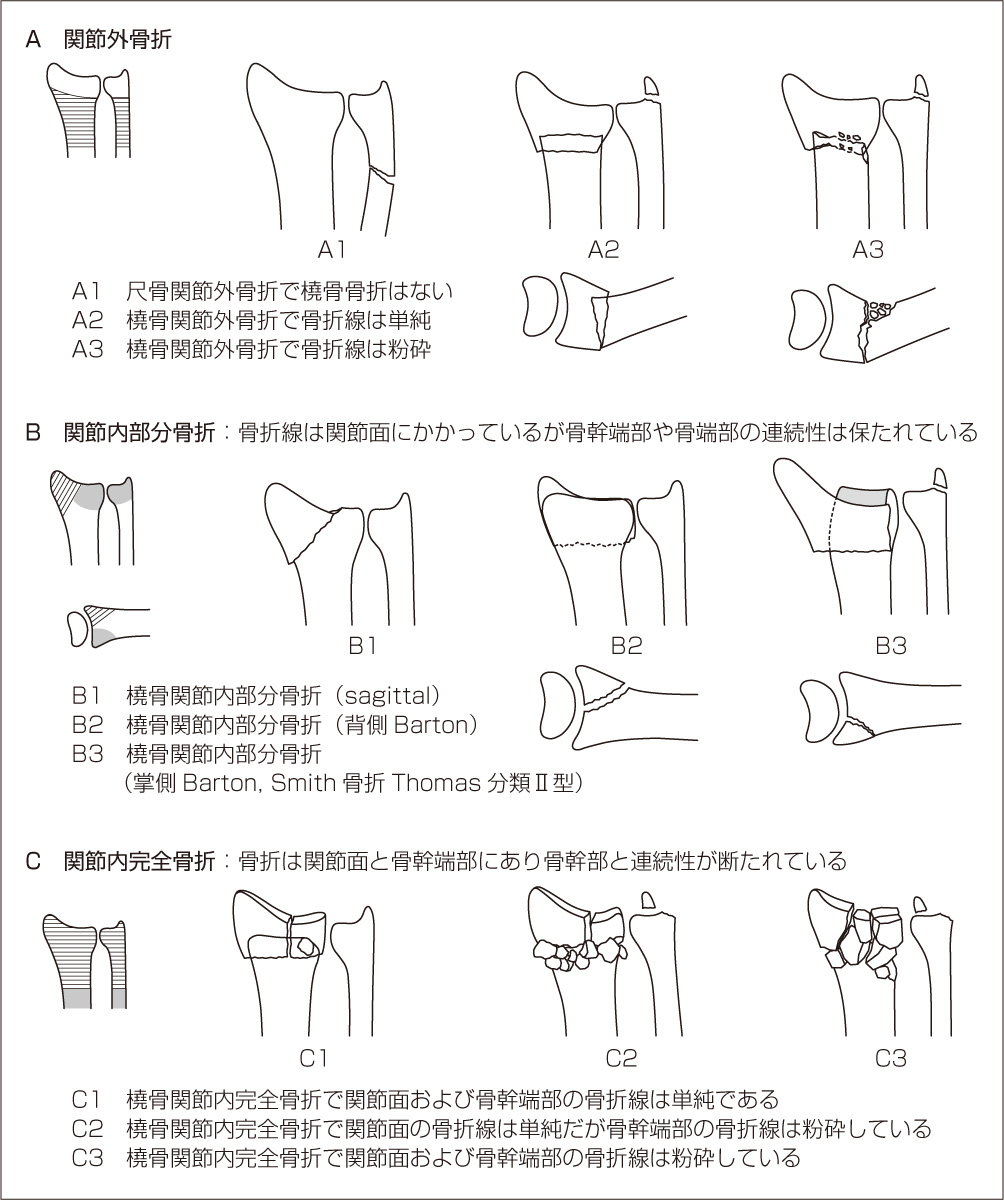 橈骨遠位端骨折　骨折タイプ分類