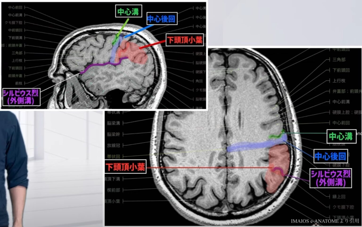 【2024年版】下頭頂小葉とゲルストマン症候群!リハビリによる日常生活への応用 – STROKE LAB 東京/大阪 自費リハビリ | 脳卒中/神経系