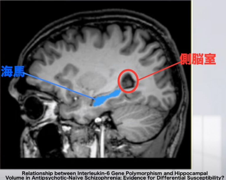 【2025年版】海馬の解剖とリハビリテーション:記憶と空間認識の回復ガイド! – STROKE LAB 東京/大阪 自費リハビリ | 脳卒中/神経系