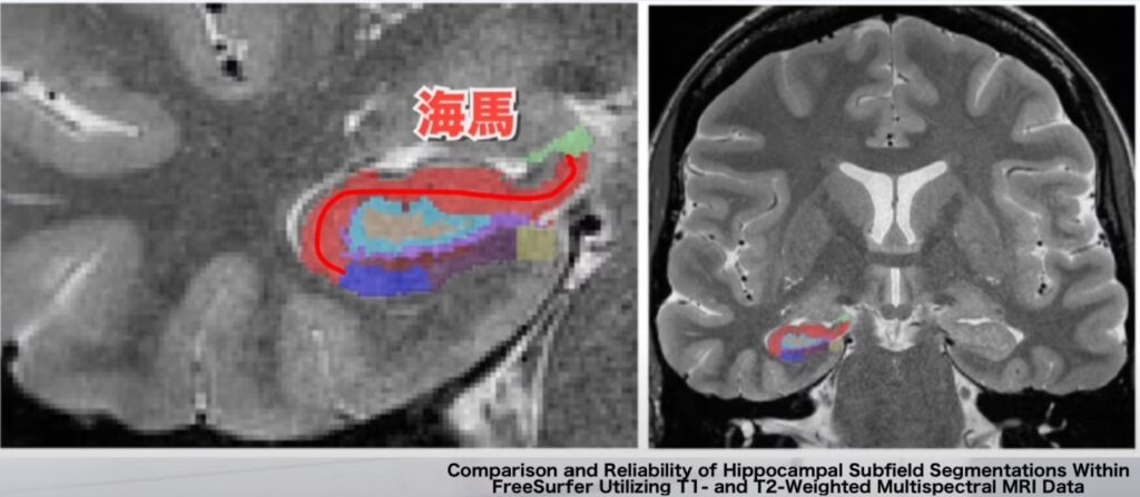 【2025年版】海馬の解剖とリハビリテーション:記憶と空間認識の回復ガイド! – STROKE LAB 東京/大阪 自費リハビリ | 脳卒中/神経系