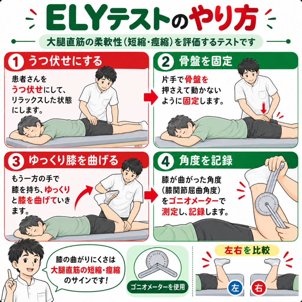 ELYテストの腹臥位、骨盤固定、膝屈曲、角度測定までの評価手順を解説した図