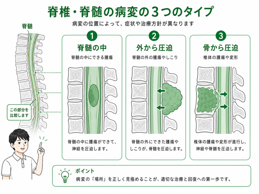 脊椎・脊髄の病変の３つのタイプ