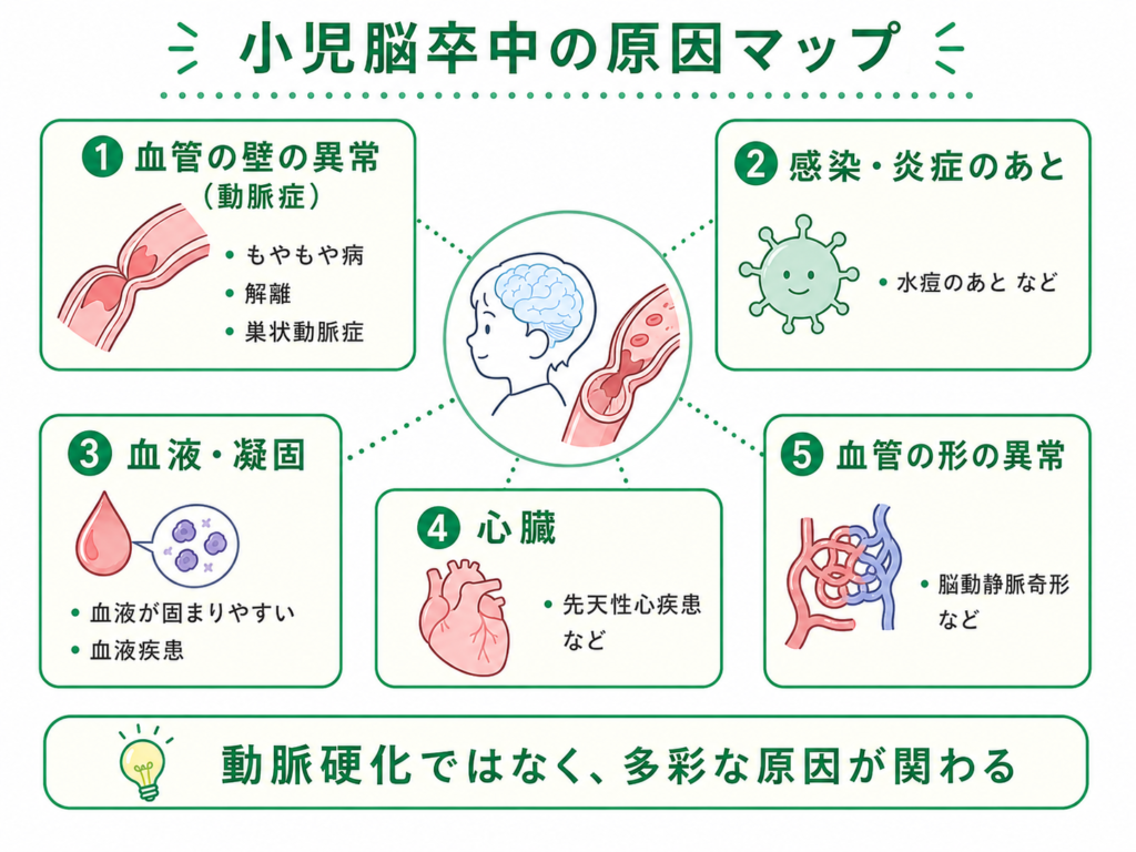 小児脳卒中の原因