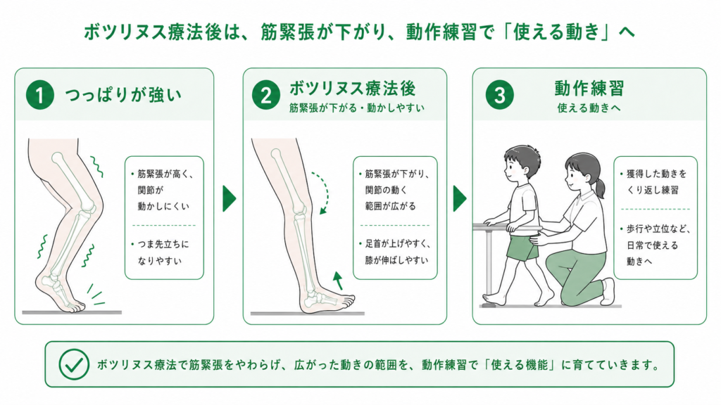 ボツリヌス療法・SDR後のリハビリ｜処置のあとに大切な運動 – STROKE