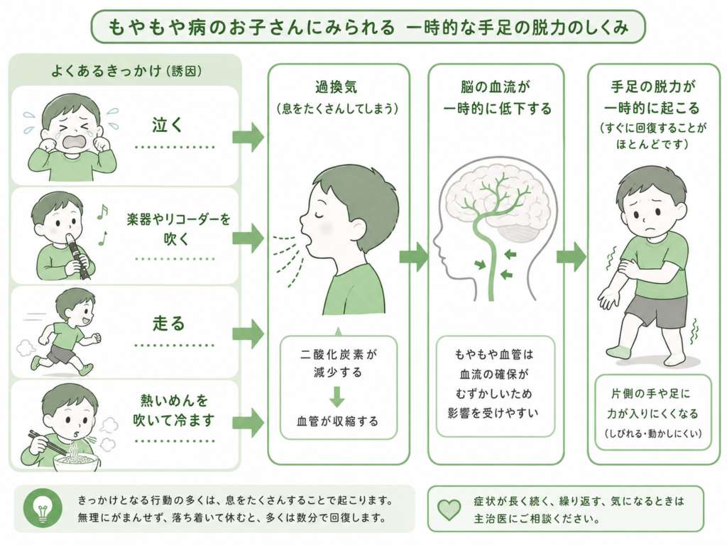 モヤモヤ病 一時的な手足の脱力