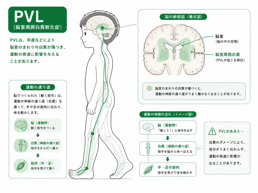 PVLとは